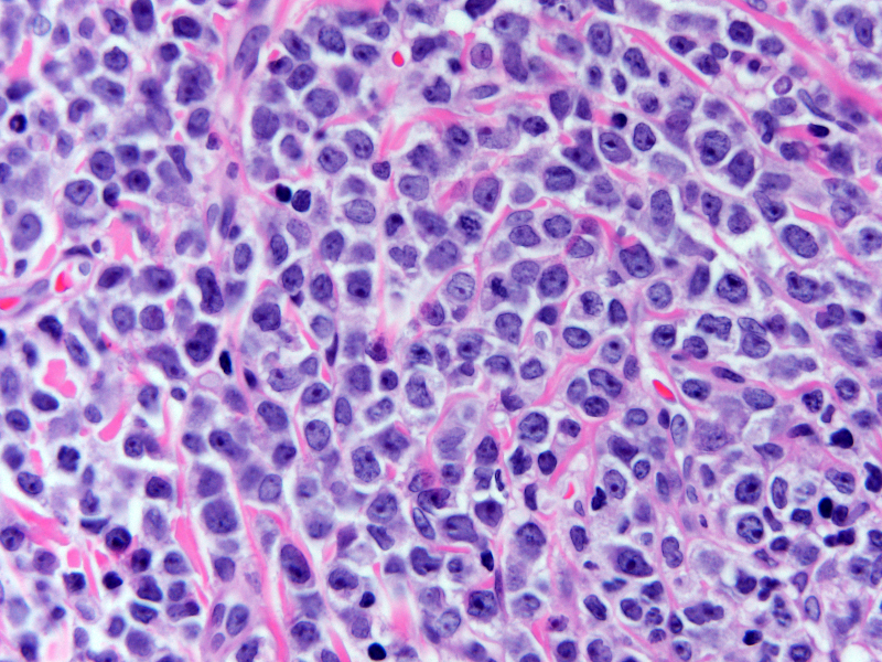 Skin of left upper thigh mass (H&E, 600X) shows a monotonous population of large mononuclear cells with fine chromatin and visible nucleoli.